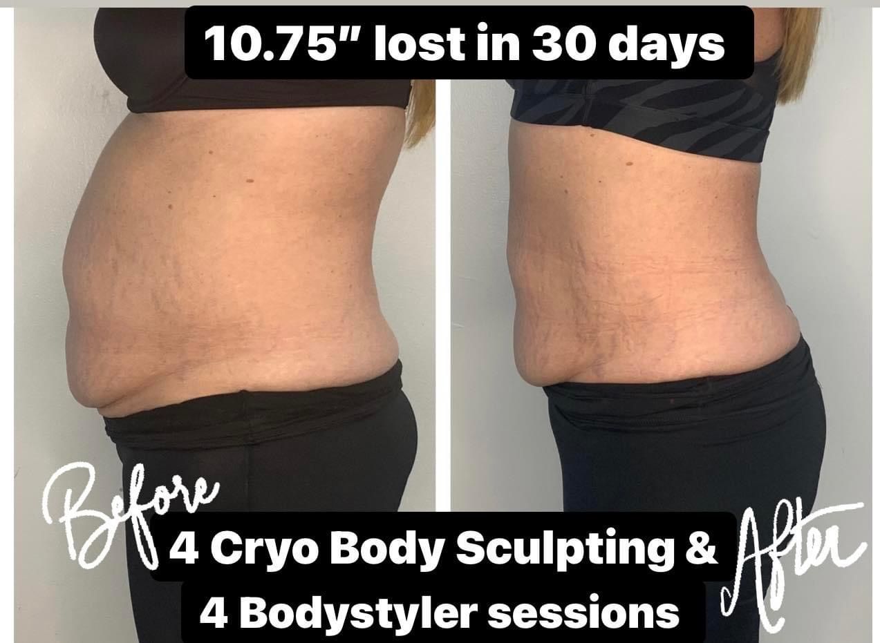 Before and after profile views of a person's torso, showing reduction in belly fat after cryo and bodystyler sessions.