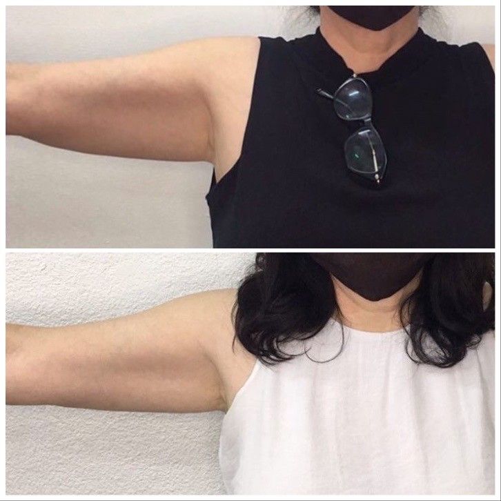 Two photos of a person's upper arm, before and after a treatment.