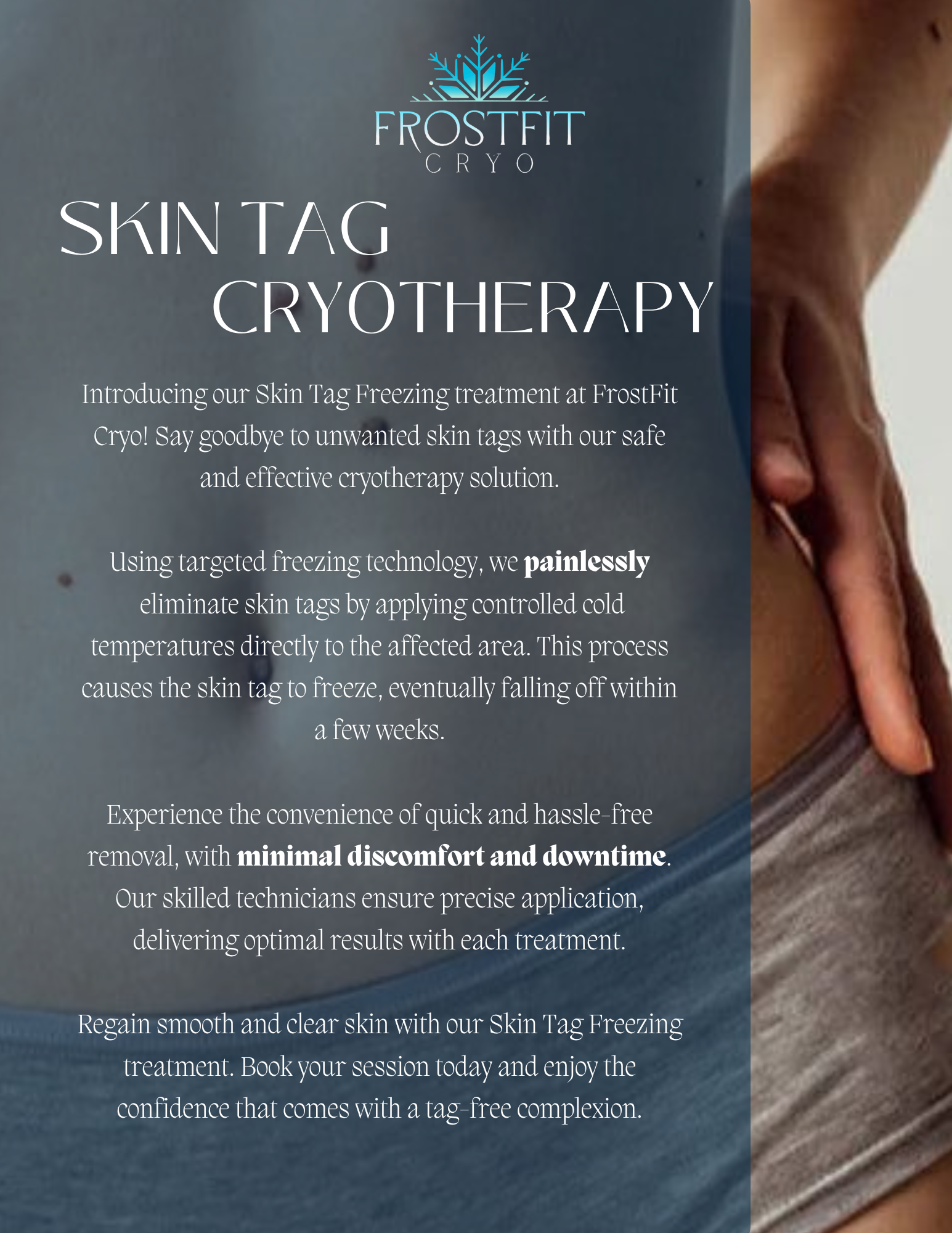 Promotional flyer for skin tag cryotherapy by Frostfit Cryo, featuring a person in underwear.
