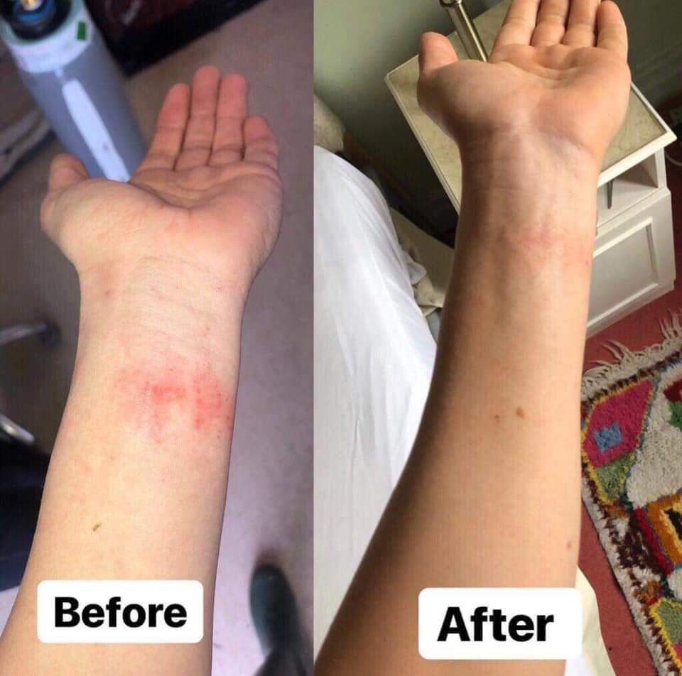 Arm with red rash before, clear skin after.