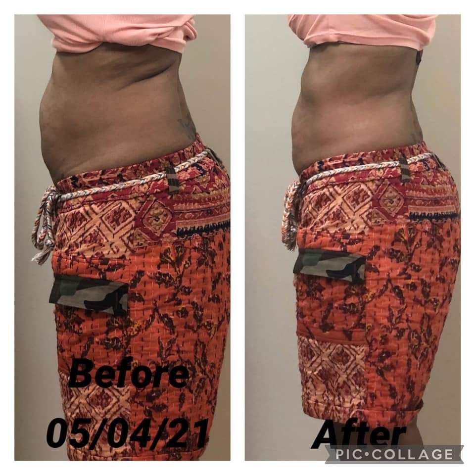 Side-by-side comparison of a person's torso. Left: Before on 05/04/21. Right: After. Shows a reduction in abdomen size.
