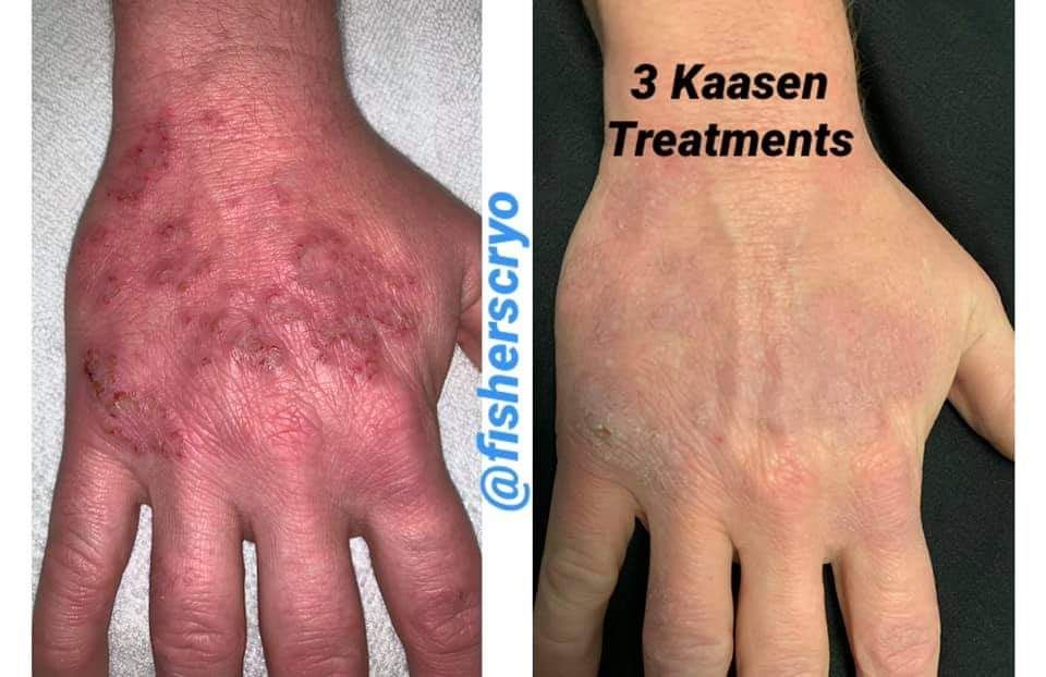 Before and after photos of a hand with red, irritated skin. After three treatments, skin appears healed.