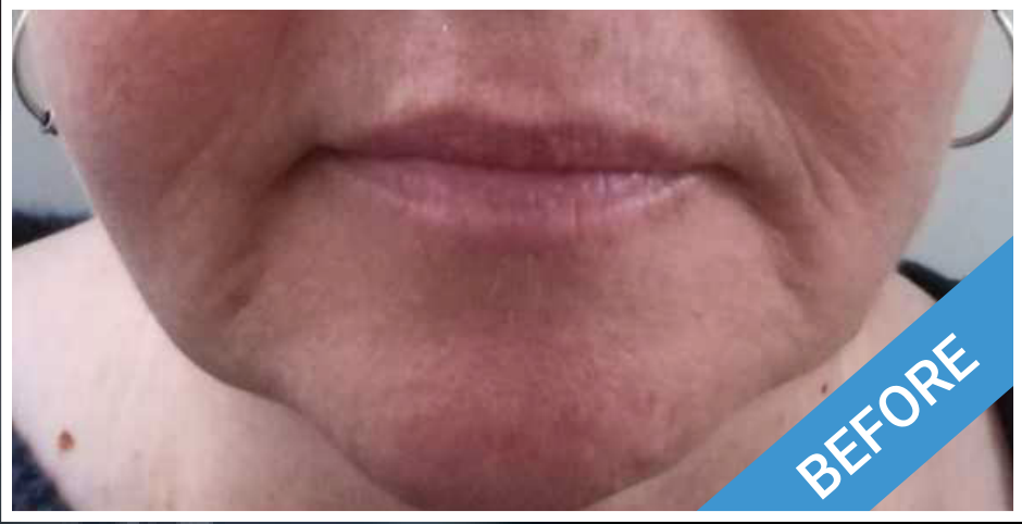 Close-up of lower face, showing wrinkles around lips and chin labeled 
