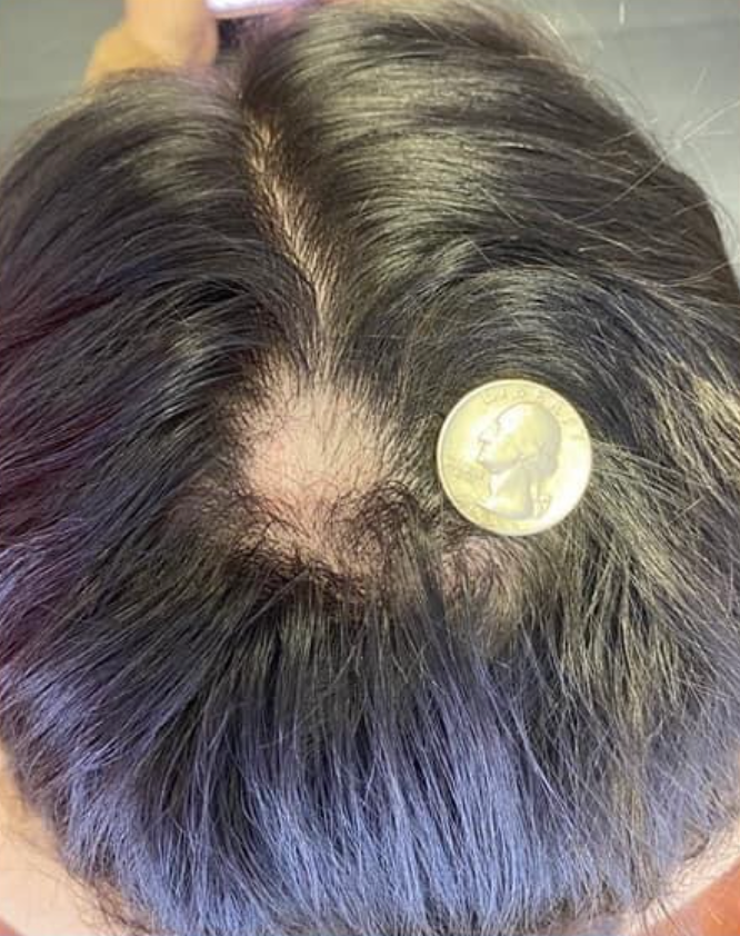 Scalp with circular bald patch, a coin placed next to it for size comparison; dark hair.
