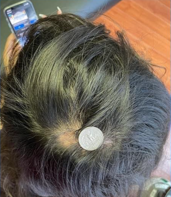 Dark hair with coin-sized bald spot on the scalp. A person holds a phone in the background.