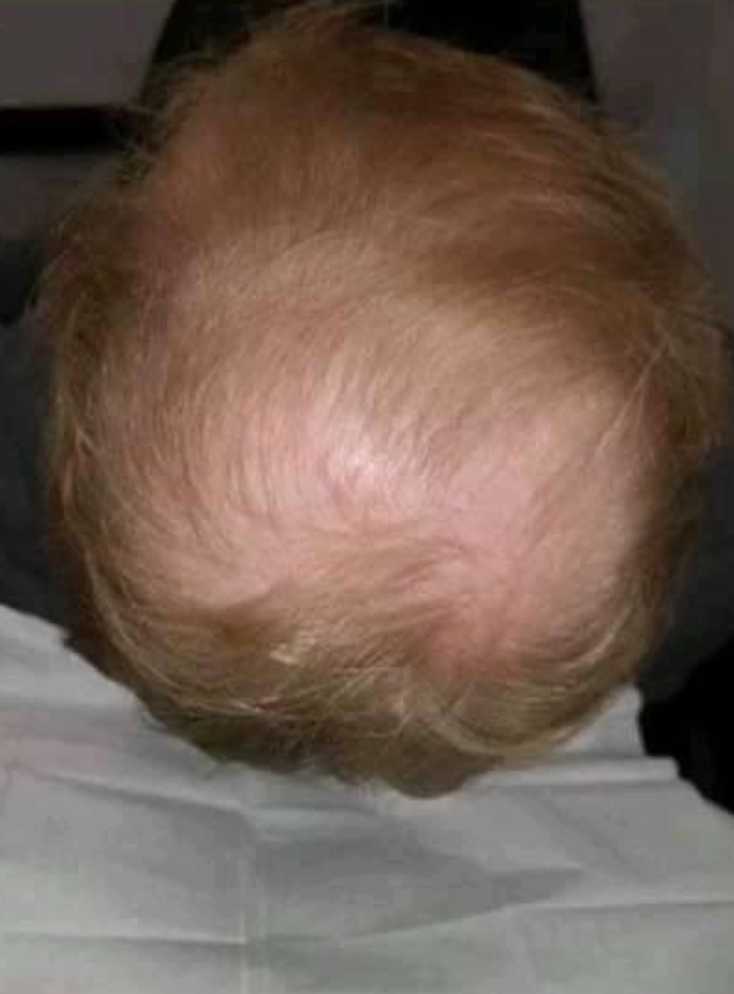 Top-down view of a light-haired scalp showing signs of hair loss.