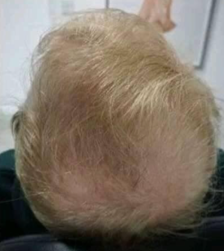 View of the top of a person's head, showing thinning blonde hair, and scalp visible in areas.