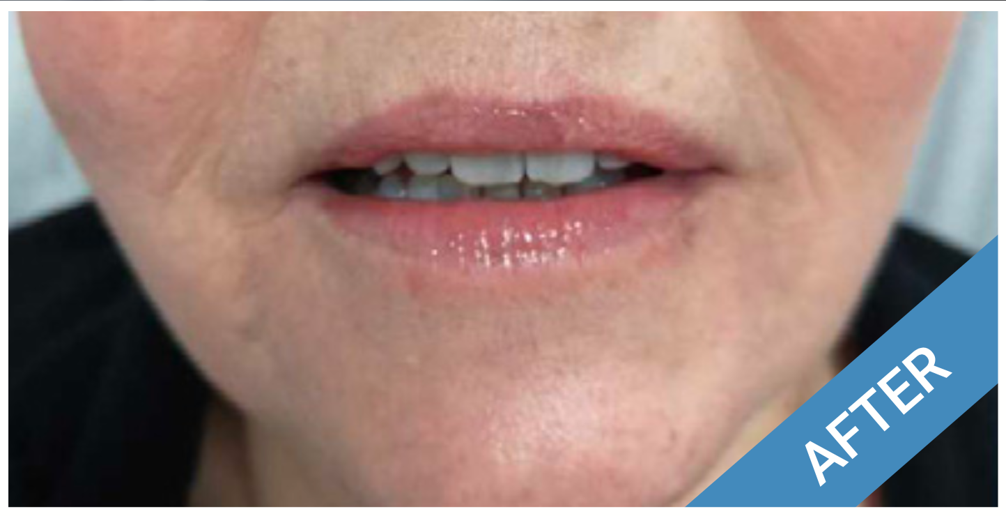Close-up of a person's mouth, lips are glossy. After treatment.