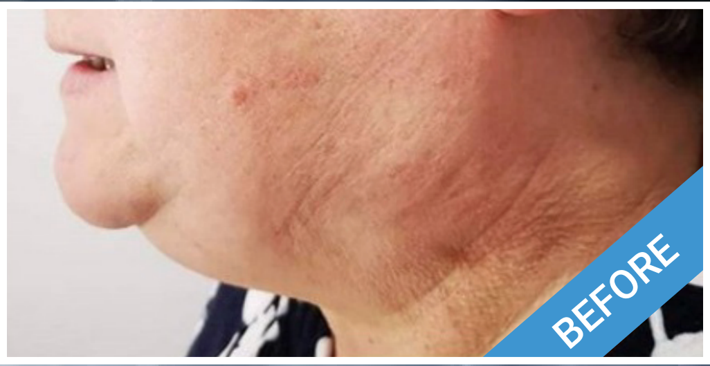 Profile view of a person's neck and chin, showing skin with wrinkles, labeled 