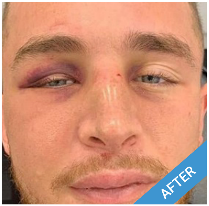 Man with bruised eye and a slight nose injury after an incident.