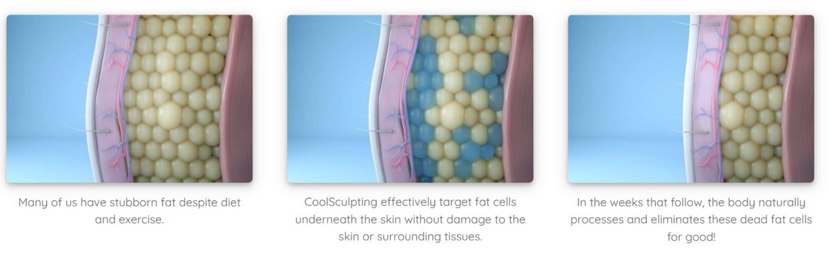 Diagram showing fat cells being treated, reducing their size, and then being removed.