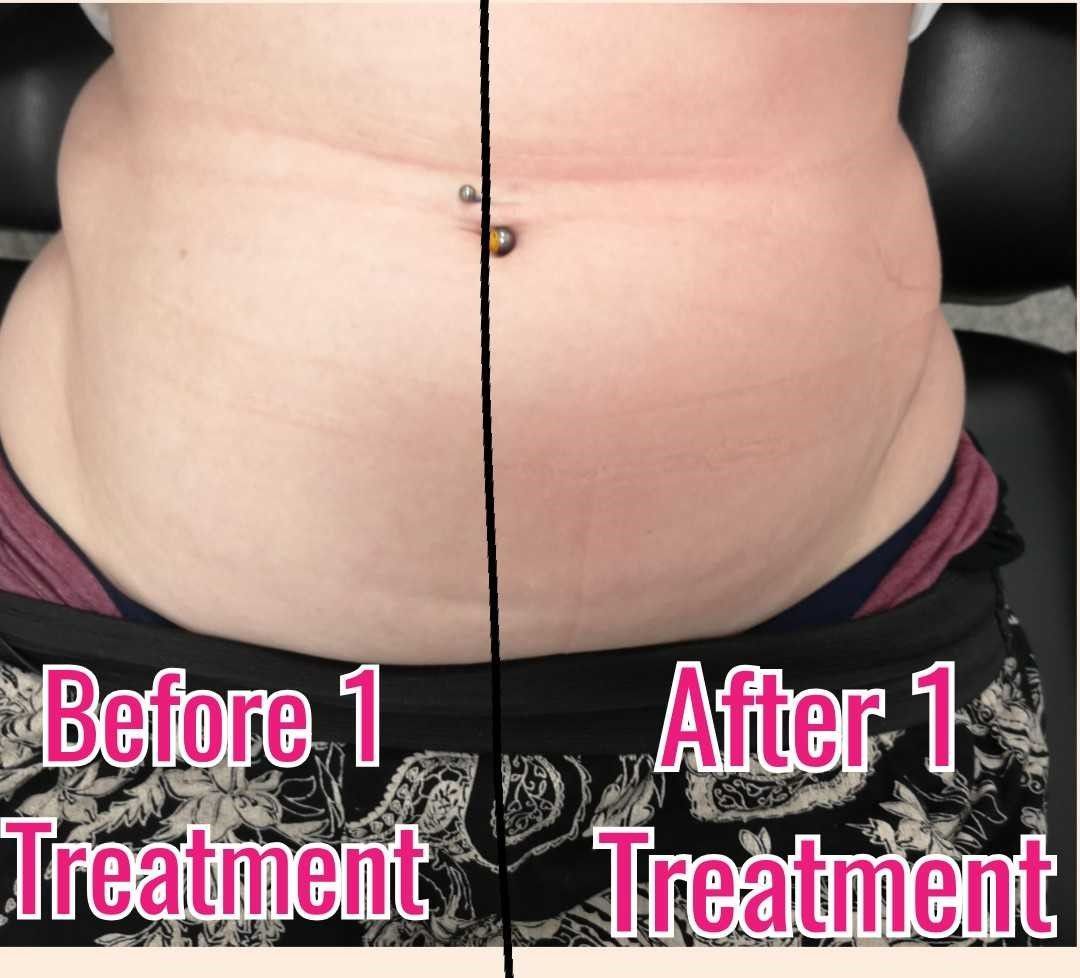 Side-by-side comparison: torso with belly button piercing. Left: before treatment, right: after one treatment, belly slightly smaller.