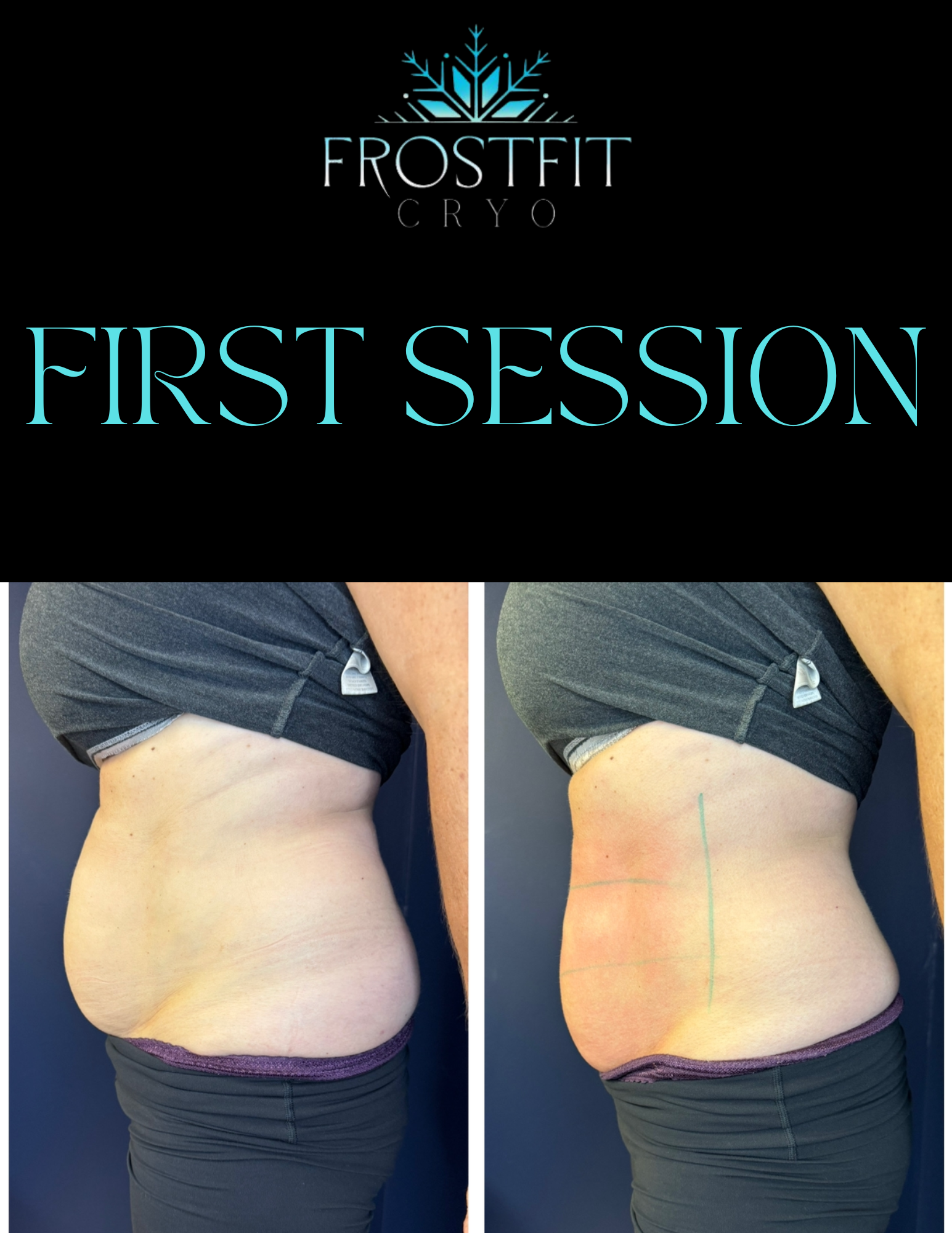 Side-by-side belly comparison. Before and after first cryo session. Reddened skin on right side.