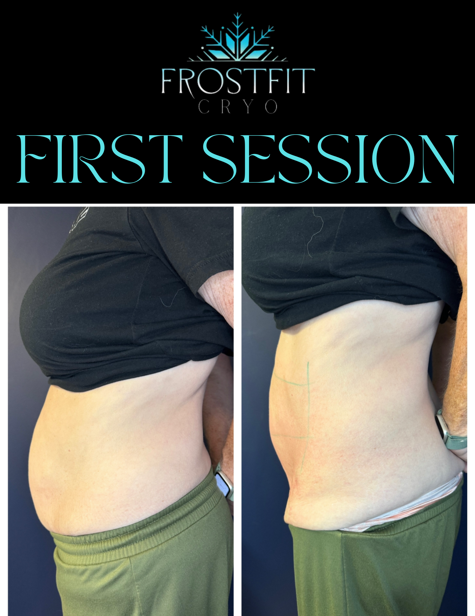 Side-by-side photos of a person's abdomen before and after cryotherapy treatment. The abdomen appears smaller after.
