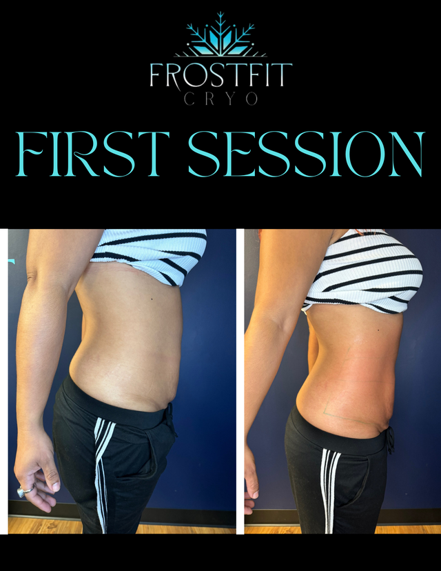 Side-by-side photos show a woman's abdomen before and after a Frostfit Cryo session. Her belly appears flatter after the session.