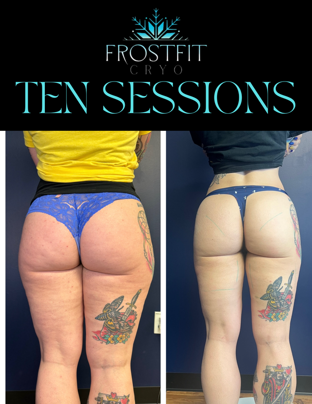Before and after of legs, showing cellulite reduction. Text "TEN SESSIONS" with Frostfit Cryo logo.