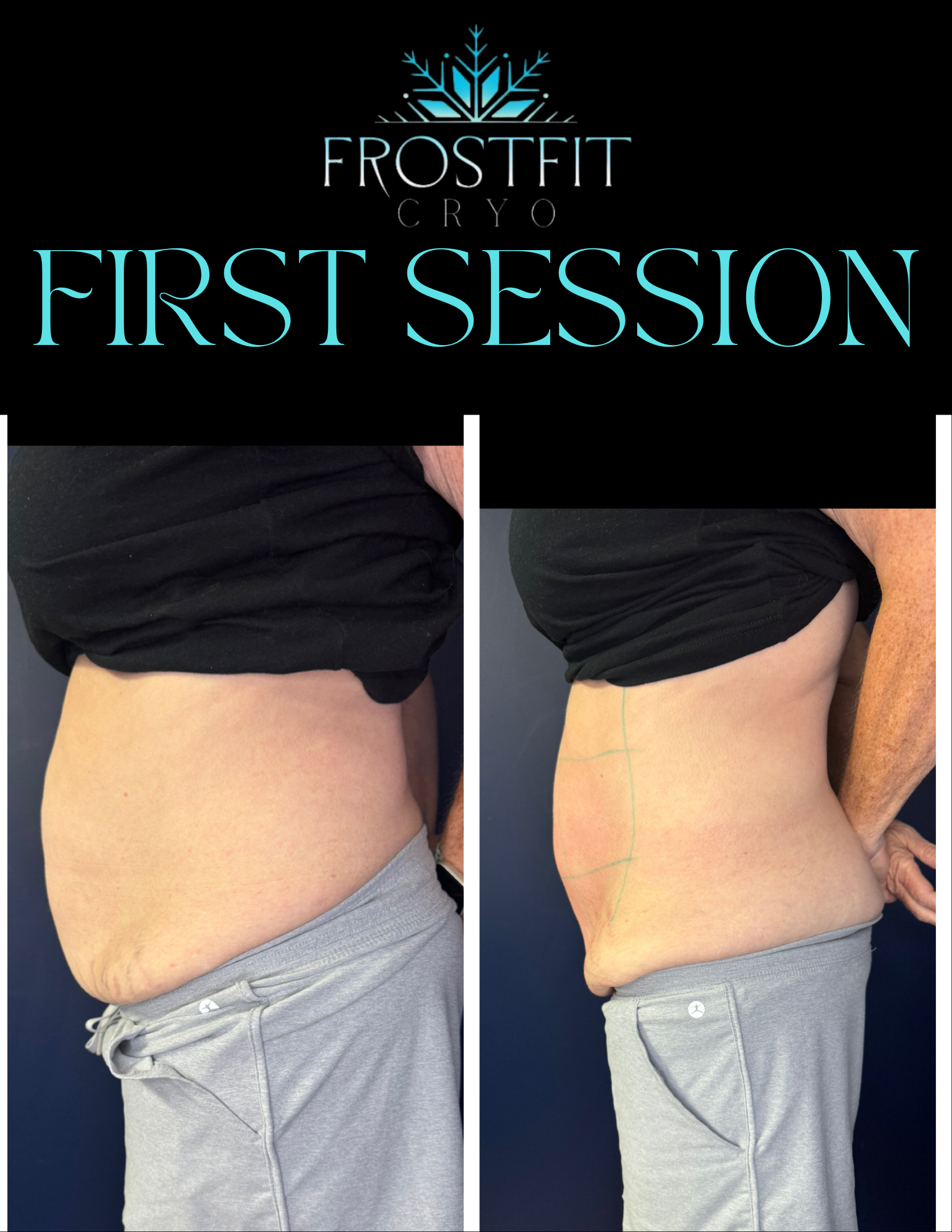 Before and after photos of a person's torso, demonstrating a slimming effect. The words 