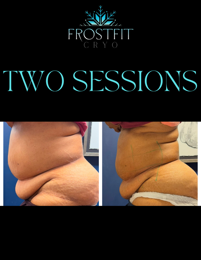 Before and after abdomen images, dark background, "Frostfit Cryo" logo, "TWO SESSIONS" text, showing body contouring results.