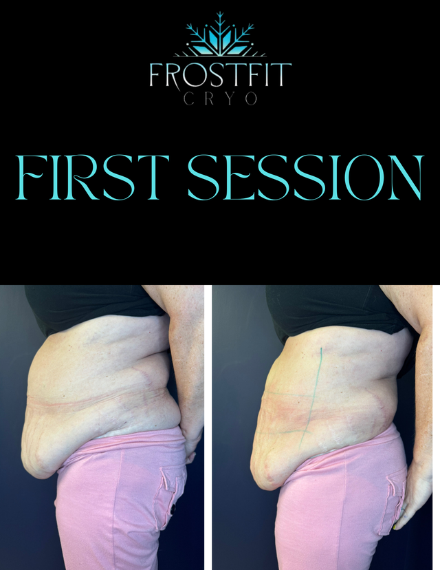 Before and after of waist after cryo session. Pink pants, black top. Frostfit Cryo logo.