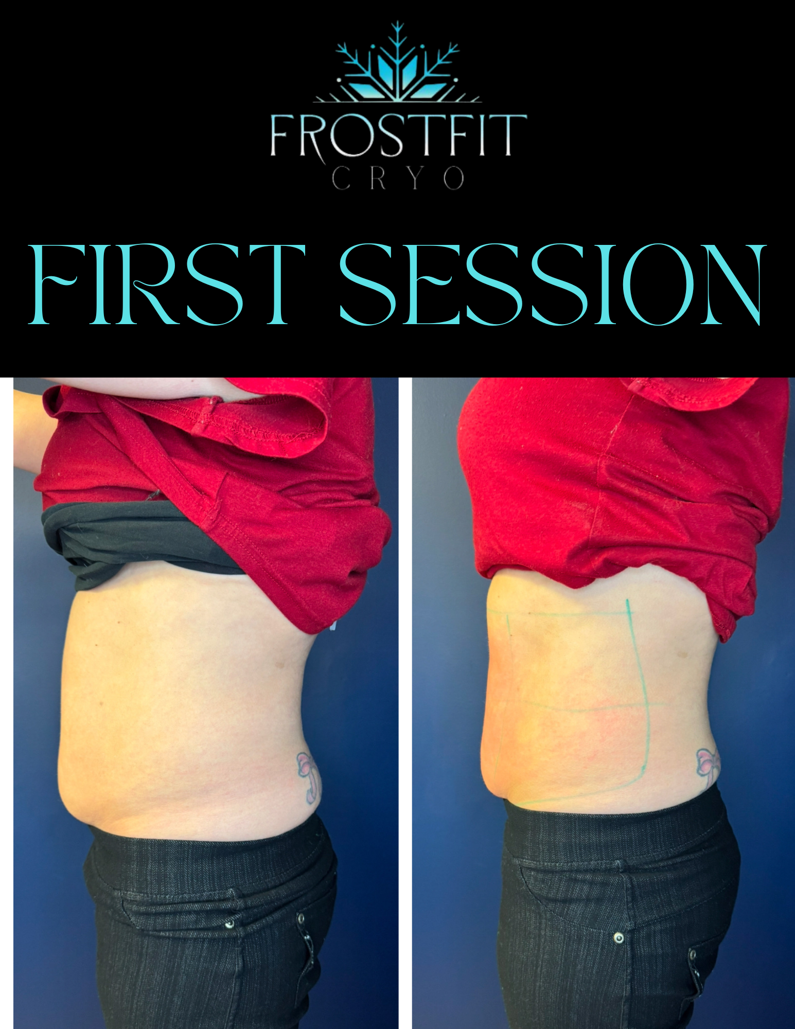 Before and after abdominal cryotherapy, showing reduction in fat.