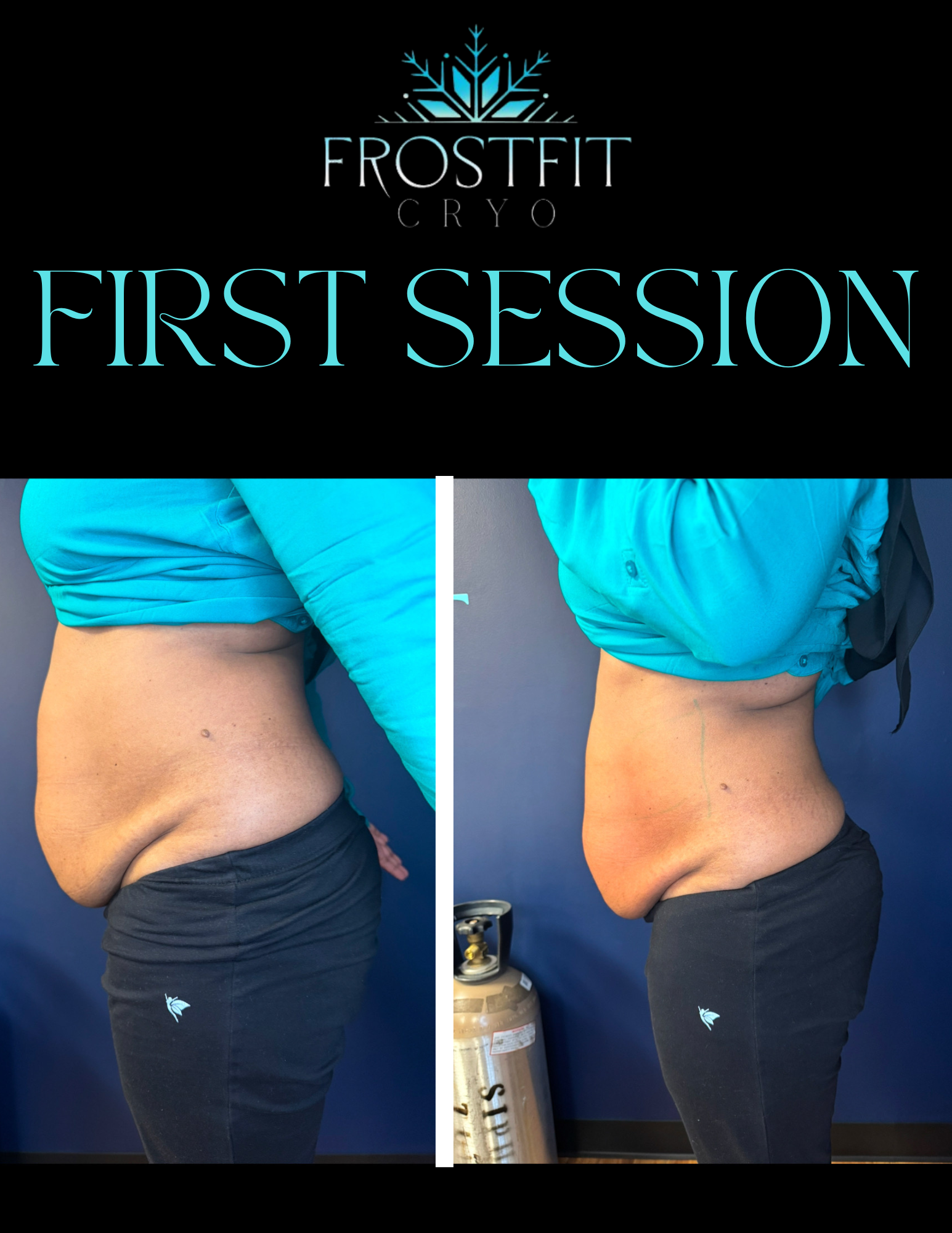 Before and after photos showing a person's midsection, highlighting a change after a cryotherapy session.