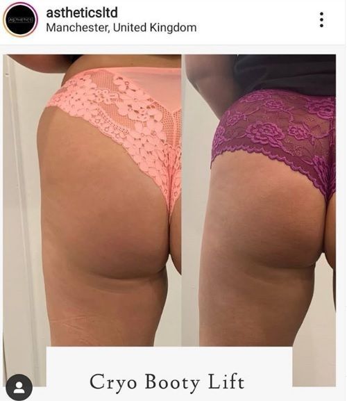 Before and after of a Cryo Booty Lift. Buttocks in pink and purple lace underwear. Manchester, United Kingdom.
