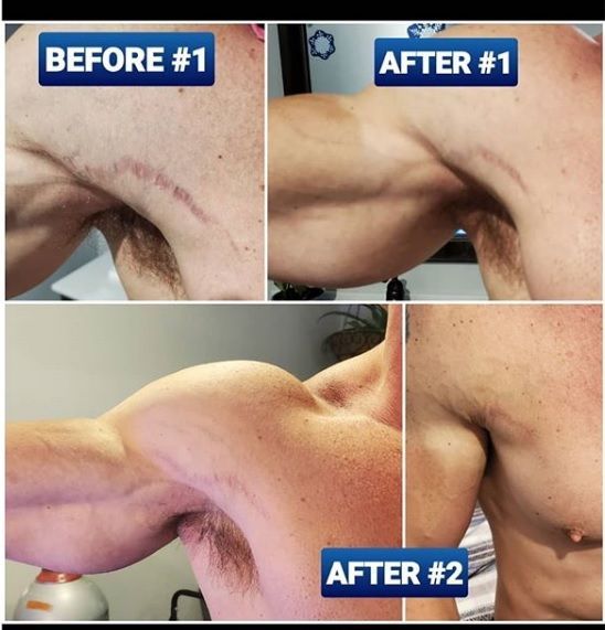 Before and after shots of a person's shoulder with a scar, showing a change in appearance after an intervention.