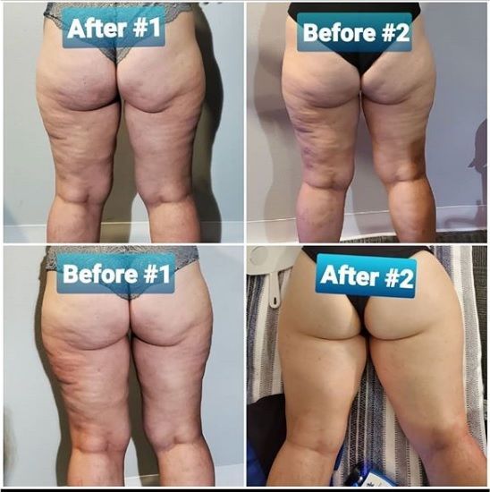 Comparison of legs, before and after treatments. Cellulite visibly reduced after two sessions.