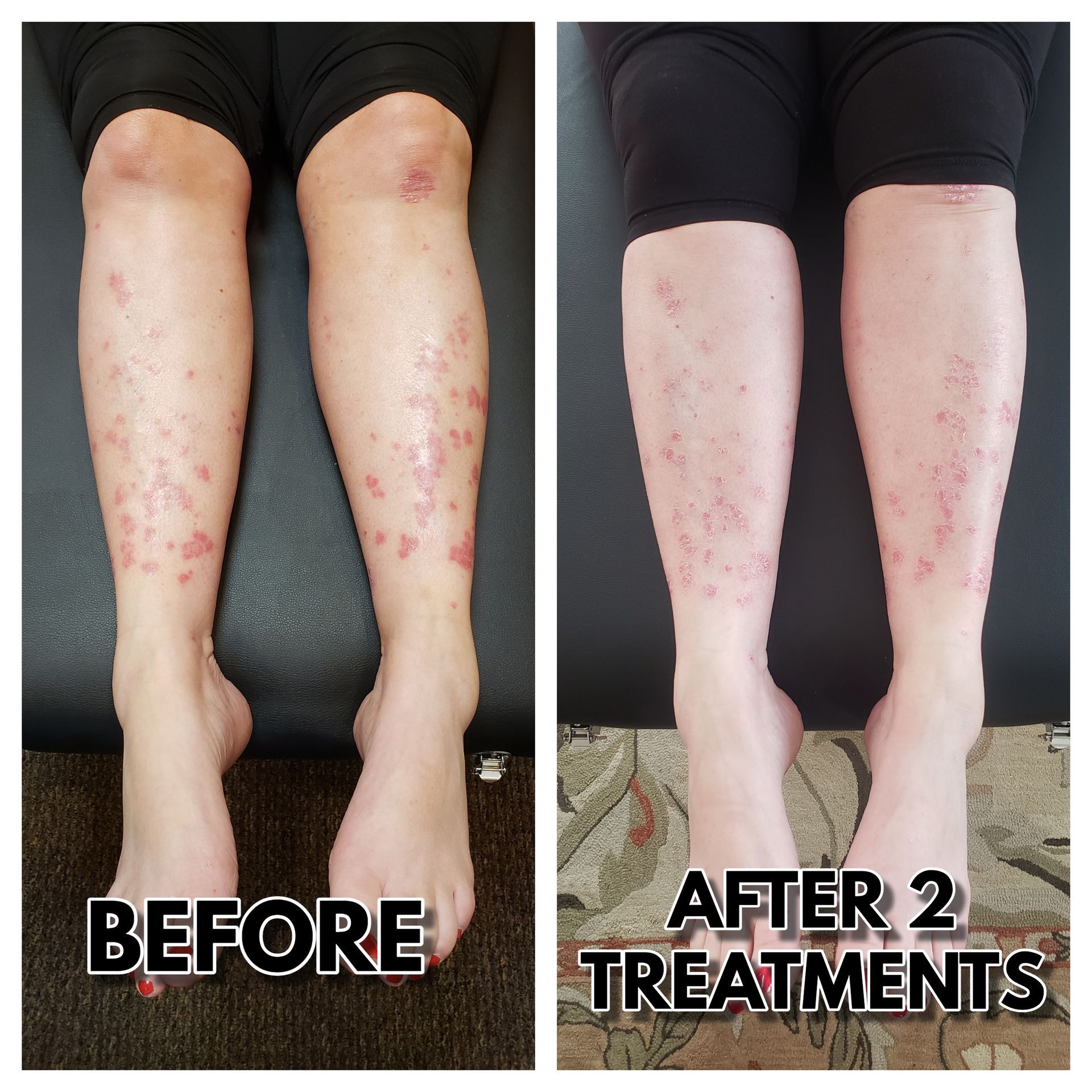 Comparison of legs before and after 2 treatments; visible red spots, skin condition treatment.