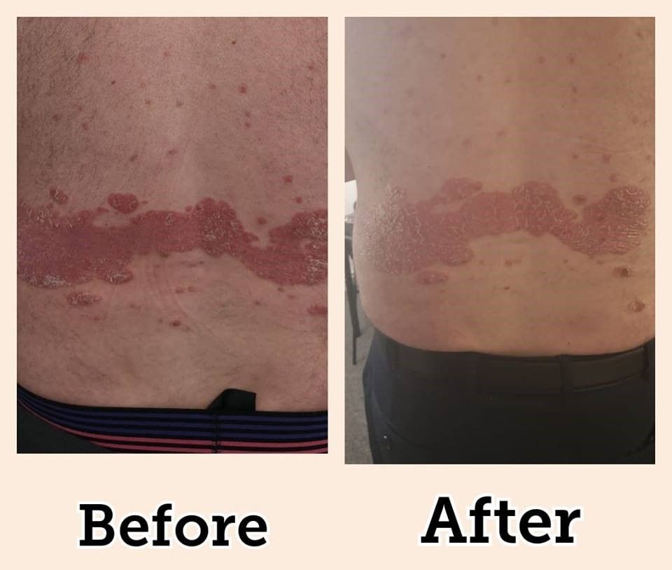 Comparison of a person's back showing a red rash, before and after treatment, possibly shingles.
