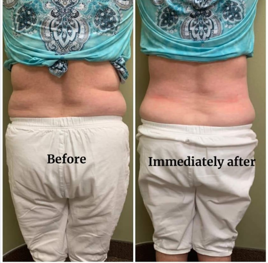 Before and after photos of a person's lower back. Before: rolls. After: less rolls, skin is red.