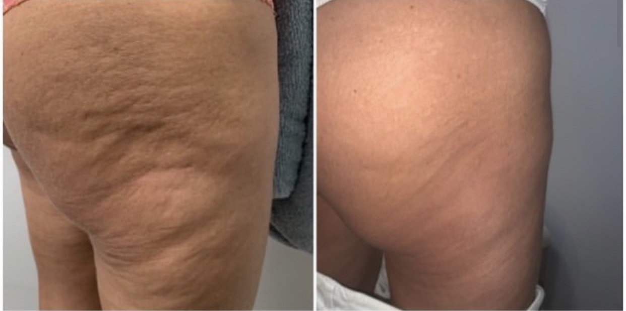 Before and after photos of a thigh affected by cellulite. The after photo shows smoother skin.