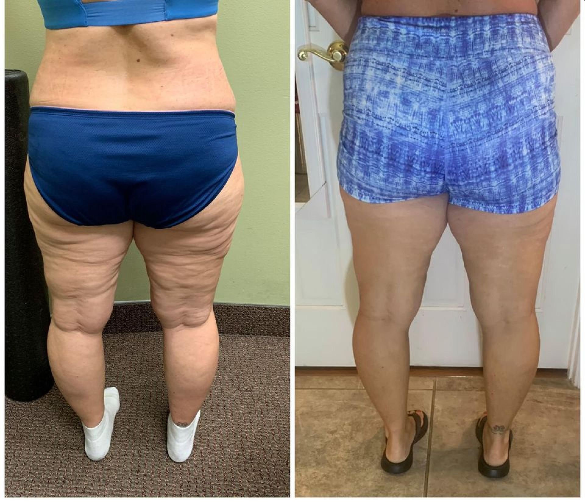 Before and after comparison of legs. Visible reduction in skin texture and size after a treatment.