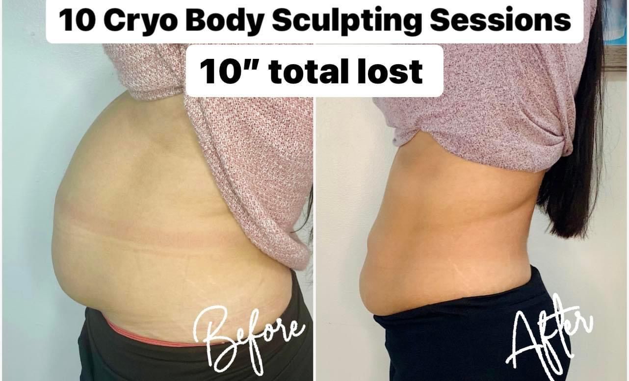 Side-by-side comparison shows a person's abdomen before and after 10 Cryo body sculpting sessions; significant inch loss.