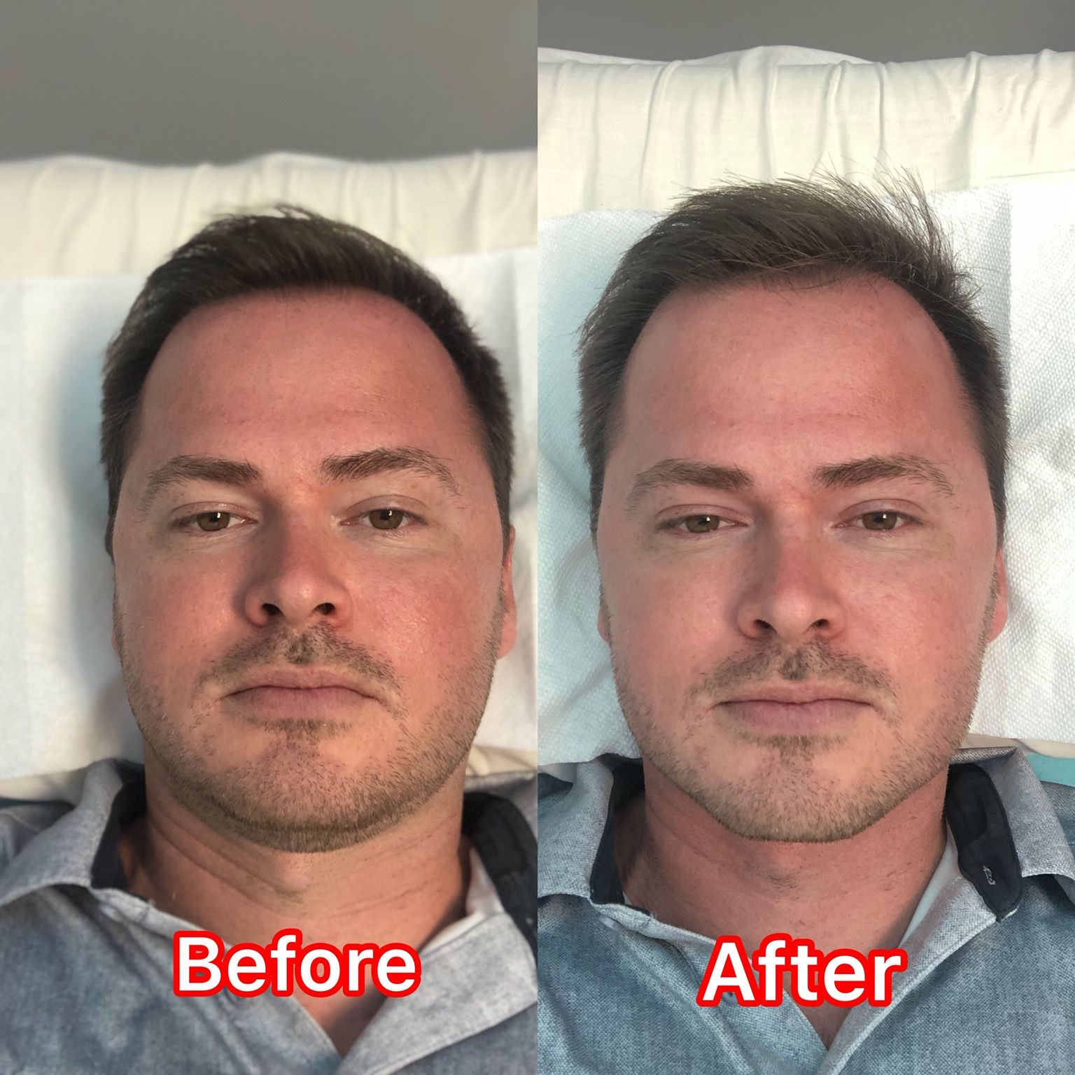 Side-by-side comparison of a man's face before and after a cosmetic procedure, showing less redness.