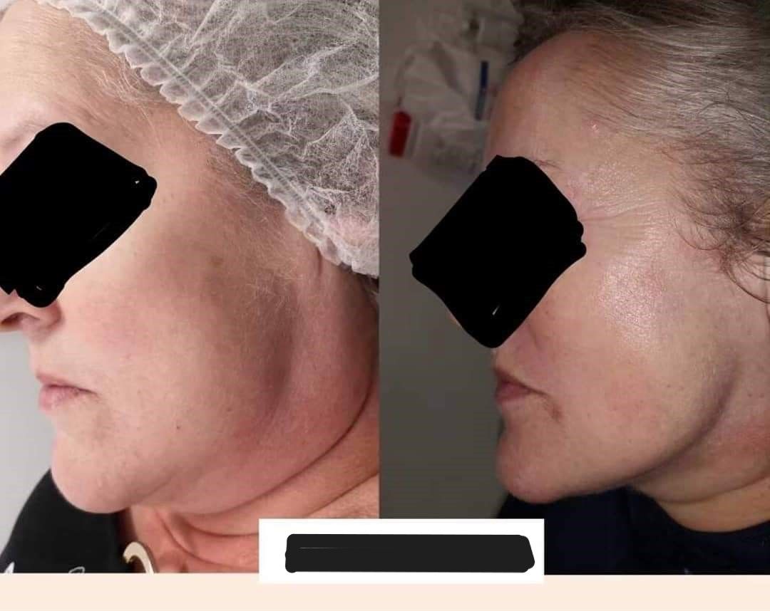 Side-by-side comparison of a person's face. Left side shows before, right side shows after treatment, showing tightening.