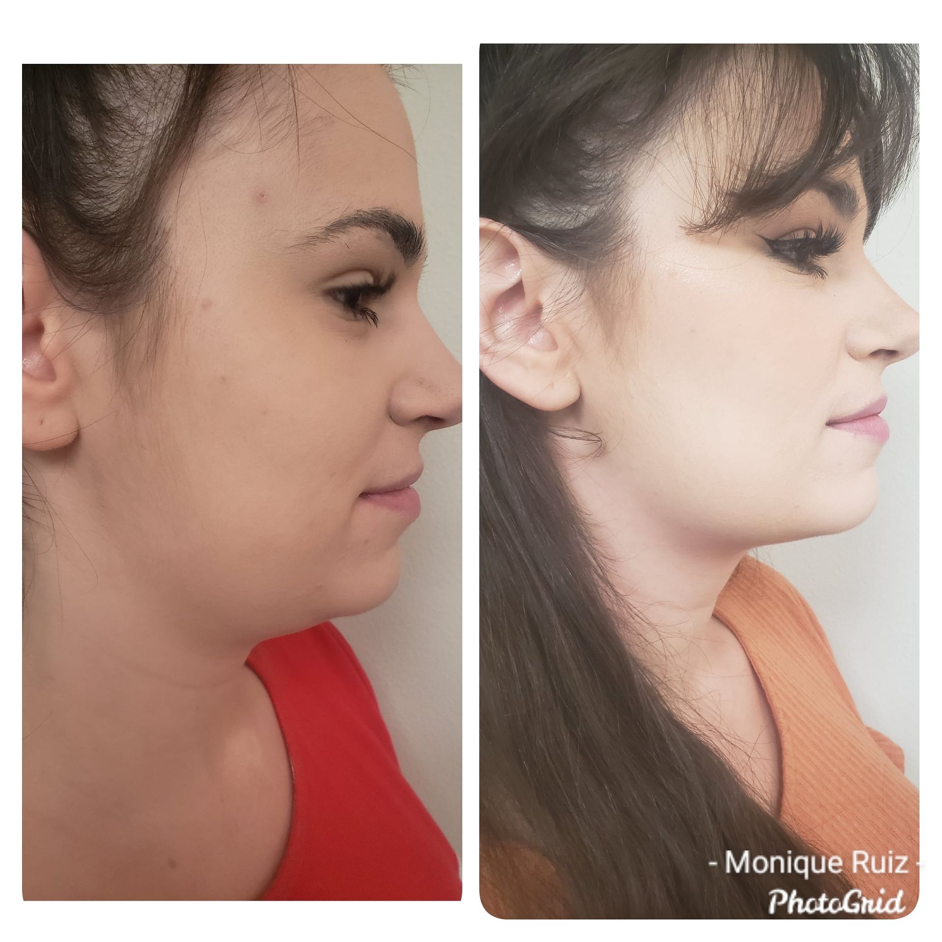 Side-by-side photos comparing before and after facial contouring. The subject's jawline and neck appear more defined in the after photo.