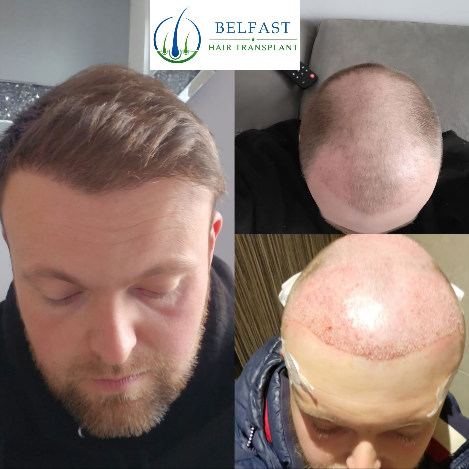 Hair transplant before and after result