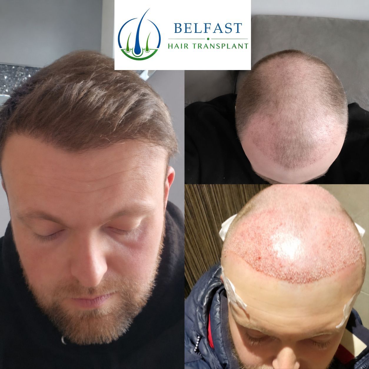 Hairline transplant before and after result