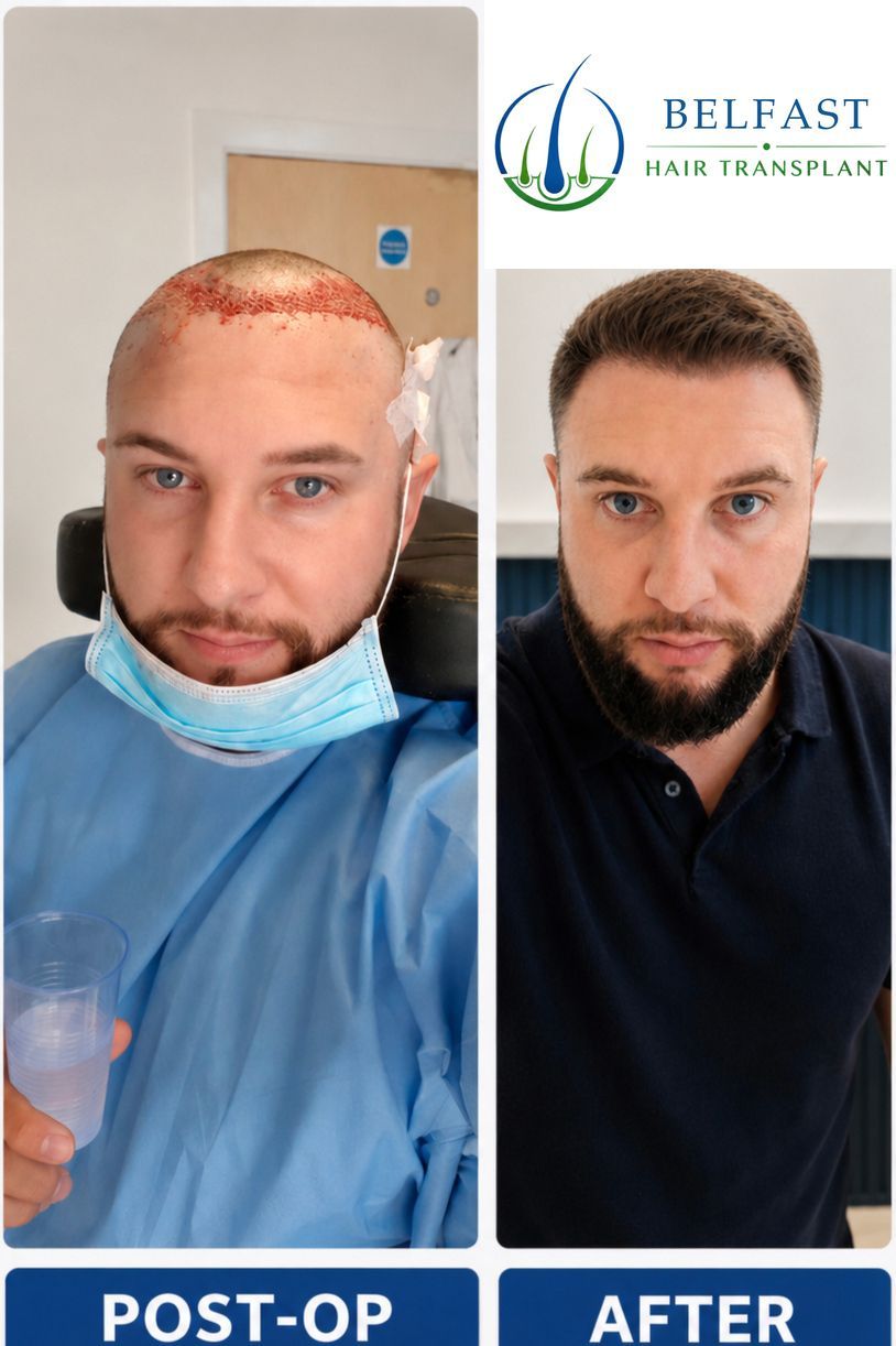 Frontal hair transplant before and after result
