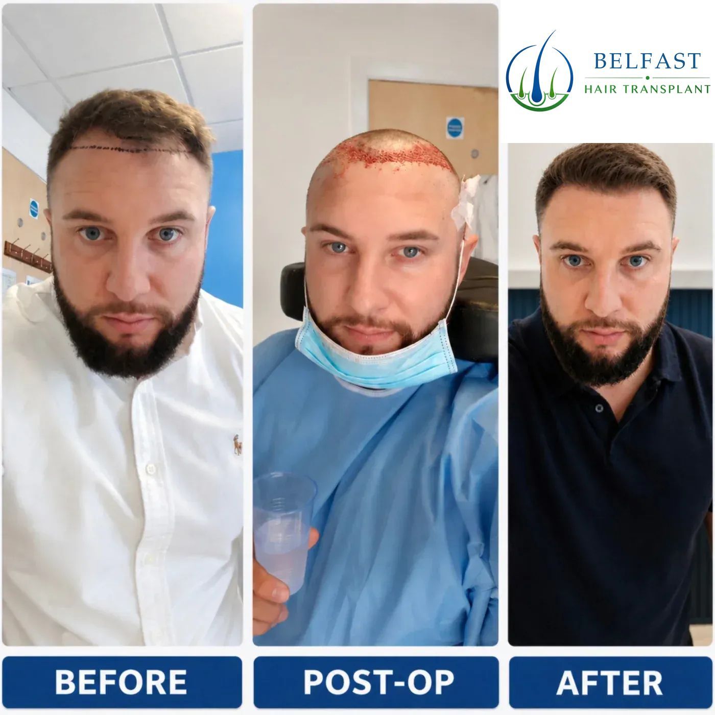 Hair transplant patient before and after result