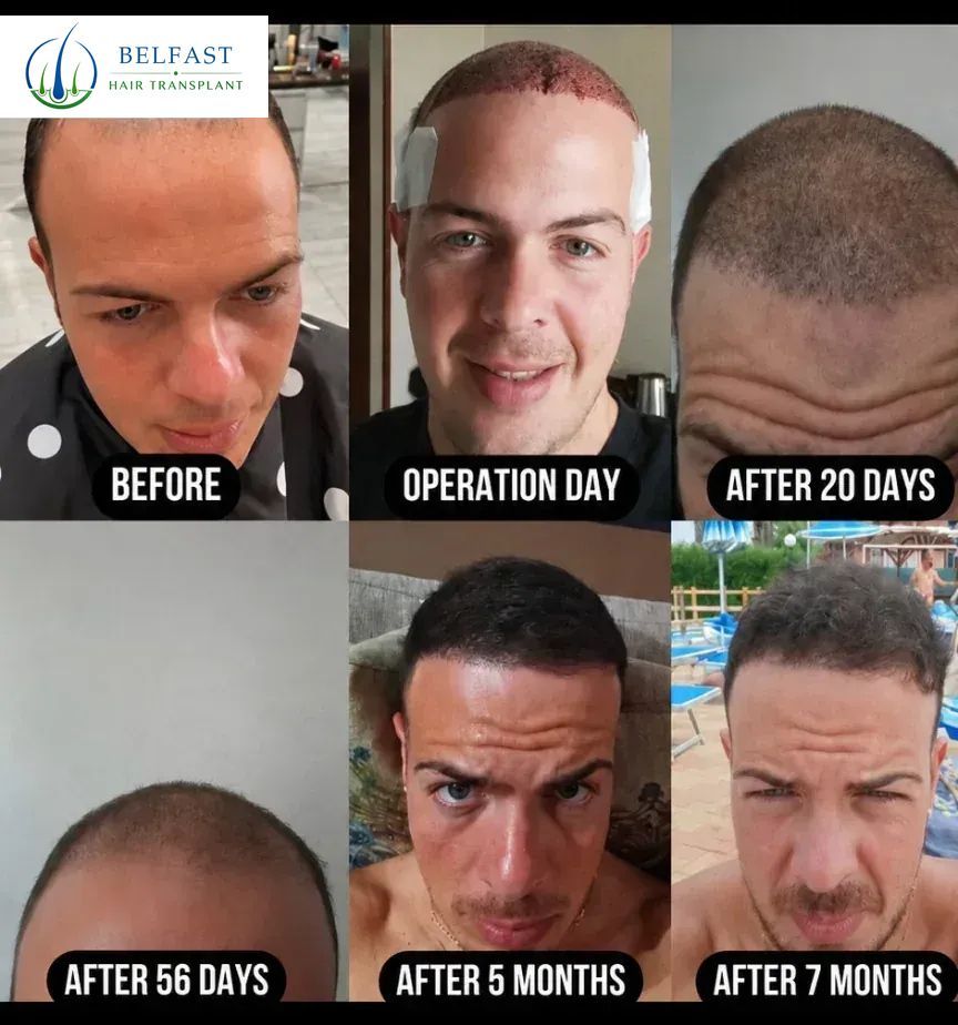 Hair transplant before and after result