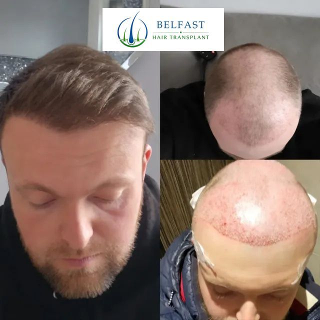 DHI hair transplant treatment result