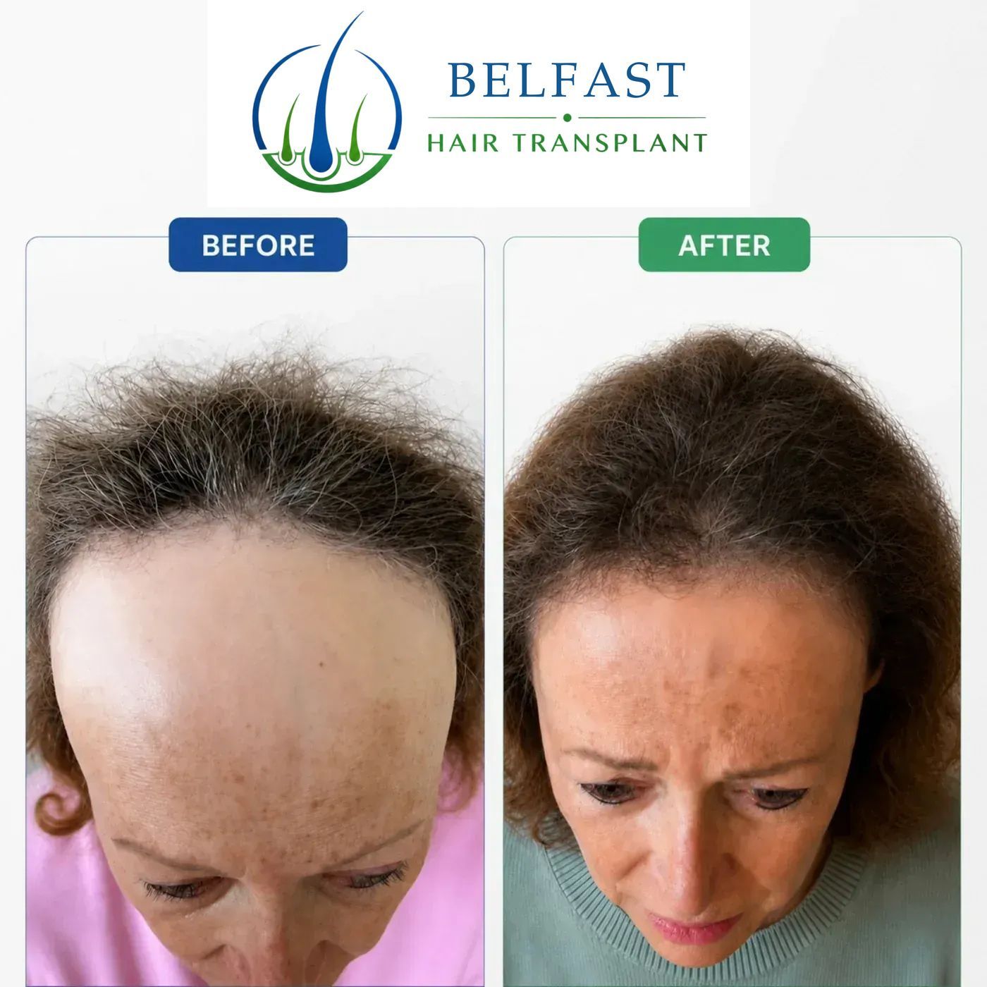 Female hair transplant before and after result
