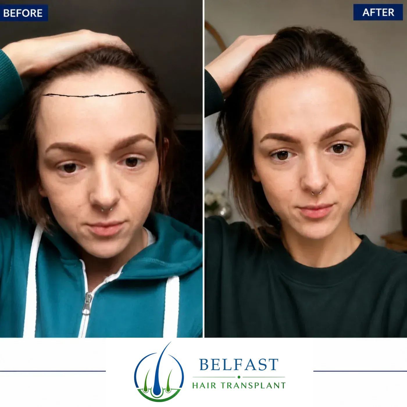 Female hairline restoration result