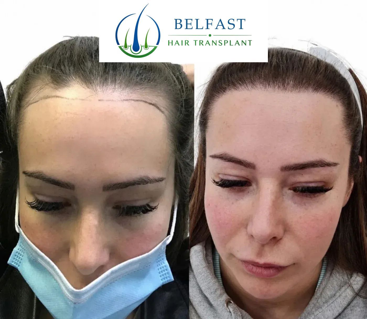 Samantha's hairline transplant result