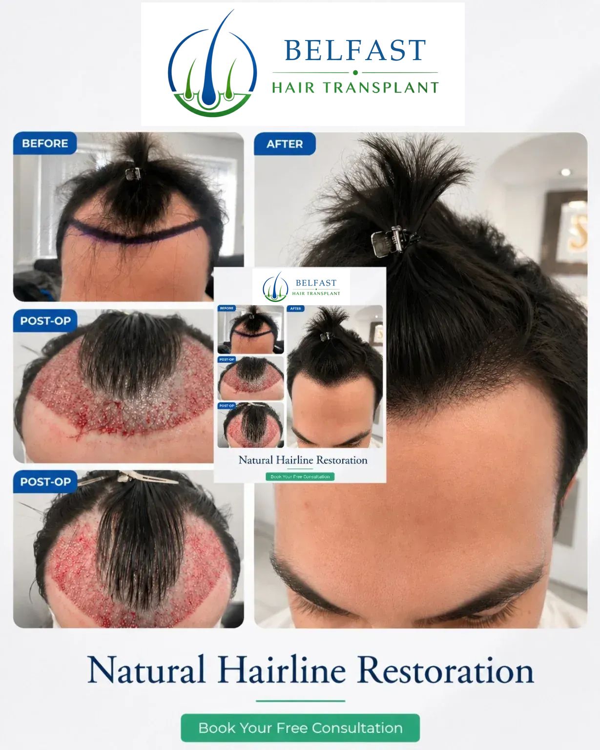 Hairline transplant before and after result