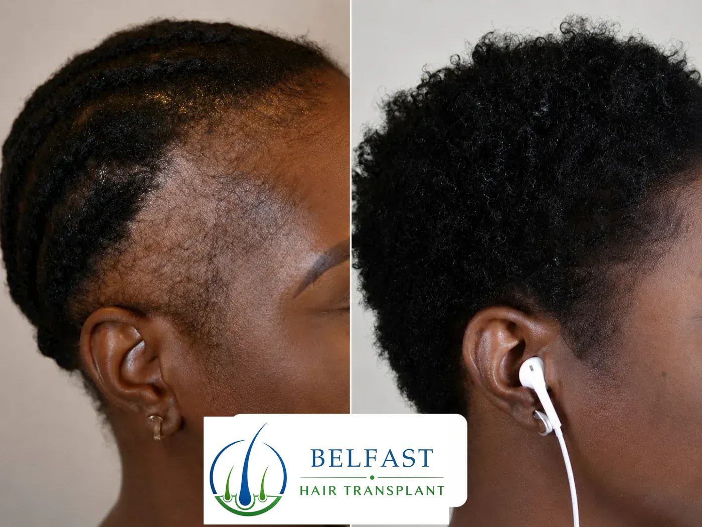 Hair-restoration before and after result