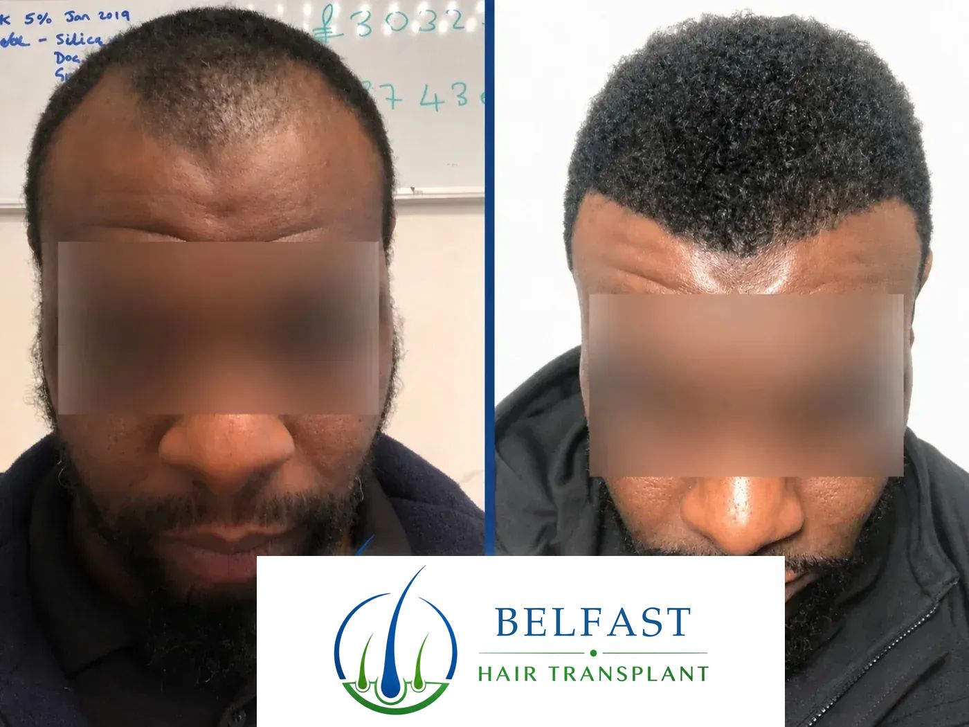 Afro hair transplant before and after result