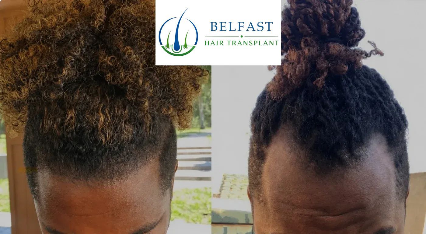 Jackie's hairline transplant result